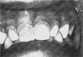 This appliance was activated for 3 months. The cross bite was corrected at this time, but it took another 3 months for the posterior to contact. (Fig 4) Fig.