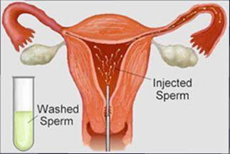 Artificial Insemination The average sperm count in men is 20 to 150 million per millilitre of semen Low sperm count classified as fewer than 20 million sperm per millilitre of semen