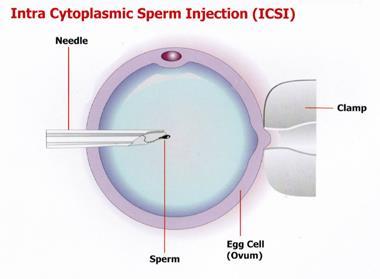 Intracytoplasmic Sperm Injection ICSI can be used if a man has a low sperm count or if his mature sperm are defective