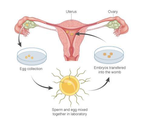 IVF Sperm collected and best selected Sperm & eggs combined in a dish containing nutrient