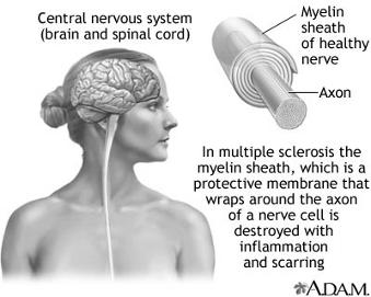 Understanding Multiple Sclerosis and EAE MS - is a severe disorder of the CNS -characterized by chronic inflammation, myelin loss, gliosis, varying degrees of axonal and oligodendrocyte pathology and
