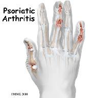 show the difference between psoriatic arthritis and other diseases.