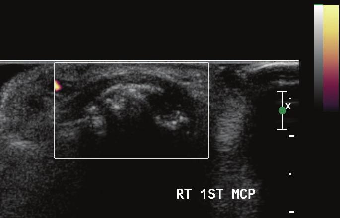 Power Doppler sonography depicts increased soft tissue vascularity and synovial inflammation. It allows for the characterization of early inflammatory changes in arthritis [13].