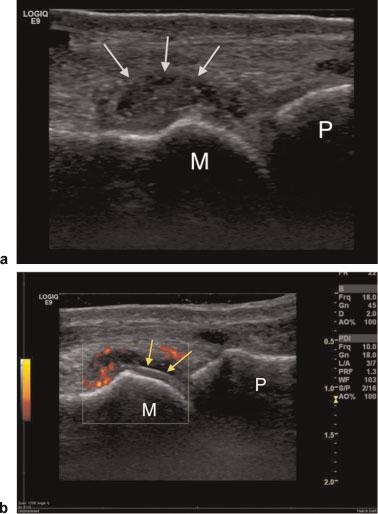 Crystal Deposition Disease and Psoriatic Arthritis O Connor 75 Fig. 1 Longitudinal sonogram of the first metatarsophalangeal joint of patient with acute gout.