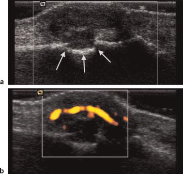 3 Longitudinal grayscale ultrasound of the metacarpophalangeal joint in a patient with gout shows urate crystal deposition on the cartilage surface of the metatarsal head (arrows).