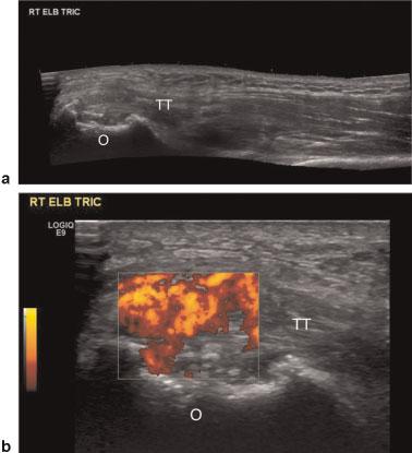 Tophi can be clinically confused with other arthritis-related nodules such as rheumatoid nodules or other deposition arthritides such as multicentric reticulohistiocytosis.