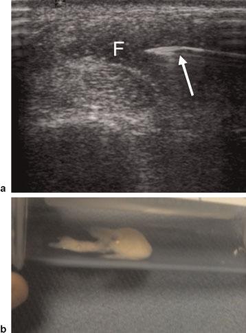 Thus aspiration and microscopy of joint fluid is often required in these cases to distinguish gout and pseudogout, especially when the patient has borderline hyperuricemia ( Fig. 9).