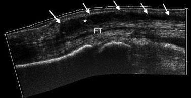 (b) T1- weighted MR image of DP of a patient with psoriatic arthritis shows pencil-in-cup deformity and new bone formation at the extensor tendon insertion (arrow). Fig.