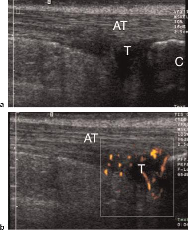 12 (a) Grayscale and (b) power Doppler images of the distal Achilles tendon (AT) show typical psoriatic entheseal disease with distal Achilles tendinopathy (T) with thickening, hypoechogenicity, and