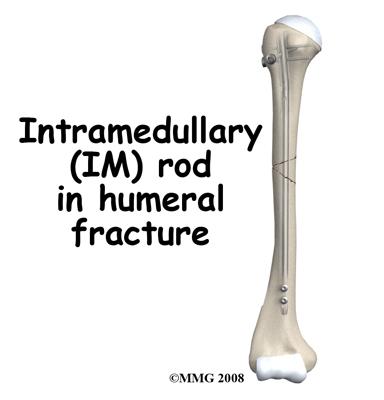Surgery Humeral shaft fractures may need surgery.