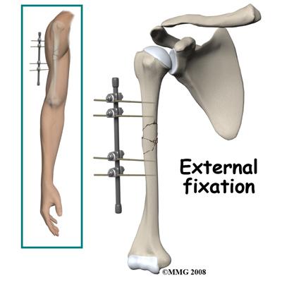 If the fracture cannot be held in acceptable position with a hanging cast or fracture brace, surgery may be suggested after several days or weeks of attempting non-surgical treatment.