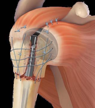Most of the time only the humeral component is implanted as the glenoid (cup side of the joint) is unaffected, as shown in the picture on the