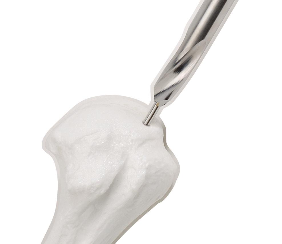 2mm Guide Pin (0100) can be placed through the tendon into the bone at the expected entry point. Confirmation should be made with the image intensifier, in both lateral and A/P views (Fig. 2).