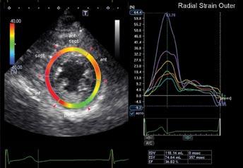 Advanced Multi-Layer Speckle Strain Permits Transmural Myocardial Function Analysis in Health and Disease: Clinical Case Examples Jeffrey C.