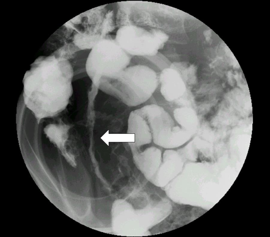 IBD Radiology Testing Traditional Modalities Upper GI with Small Bowel Follow-Through Barium Enema CT scan