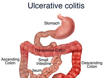 How Are Ulcerative Colitis & Crohn s Disease Different?