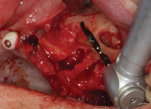 PART ONE Dentoalveolar and Implant Surgery Figure 7.3.