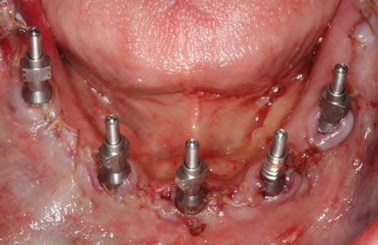 anterior posterior (A-P) spread of implants. Figure 7.6.