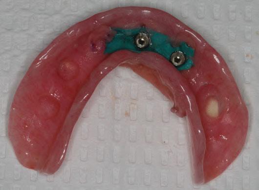 CHAPTER 7 Restoration of the Edentulous Arch Figure 7.9.