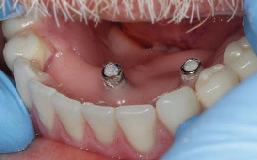 13. The mandibular denture is completely seated and held in place as the resin