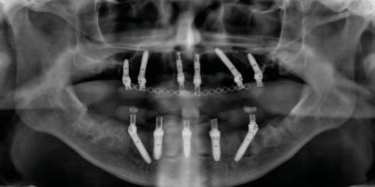 Clinical Implant Dentistry and Related Research, 5(Suppl. 1), 2 9. Parel, S. and Phillips, W., 2011.