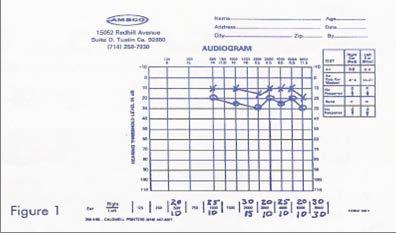 6. RECORDING RESULTS 6.1. Using a common pad, Figure 1, you may record the results as in the following example. 6.2. Write the results above and below the frequencies on bottom of audiogram pad.