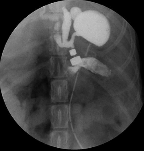 A: Abdominal X-ray examination immediately after surgery; the two parts of the magnet pair coupled very well, exhibited good patency and were leak free; B: Daily abdominal radiography until the