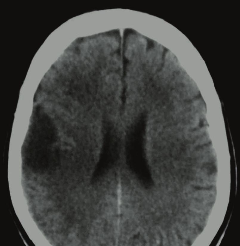 2 Case Reports in Radiology DWI ADC Figure 1: CT scan of the brain.