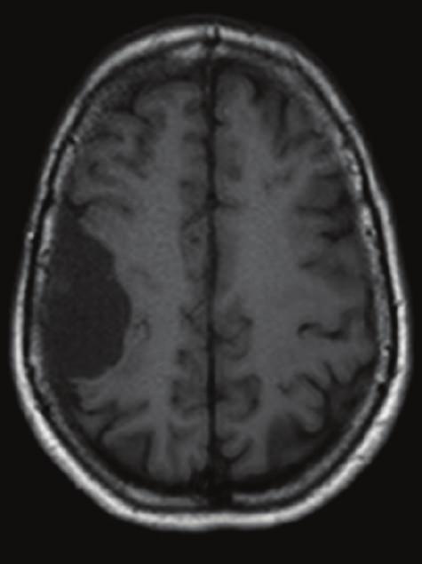 restricted than CSF. Gd Figure 2: Gadolinium-enhanced brain MRI.
