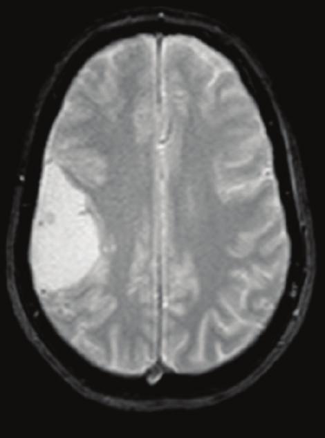 a cystic lesion containing a dense proteinaceous liquid, with a peripheral nodule of 8 mm