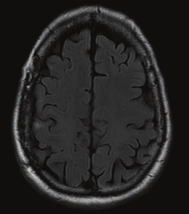Case Reports in Radiology 3 FLAIR T1 Figure 5: Control brain MRI. Three months after surgery a control brain MRI shows no lesion recurrence.