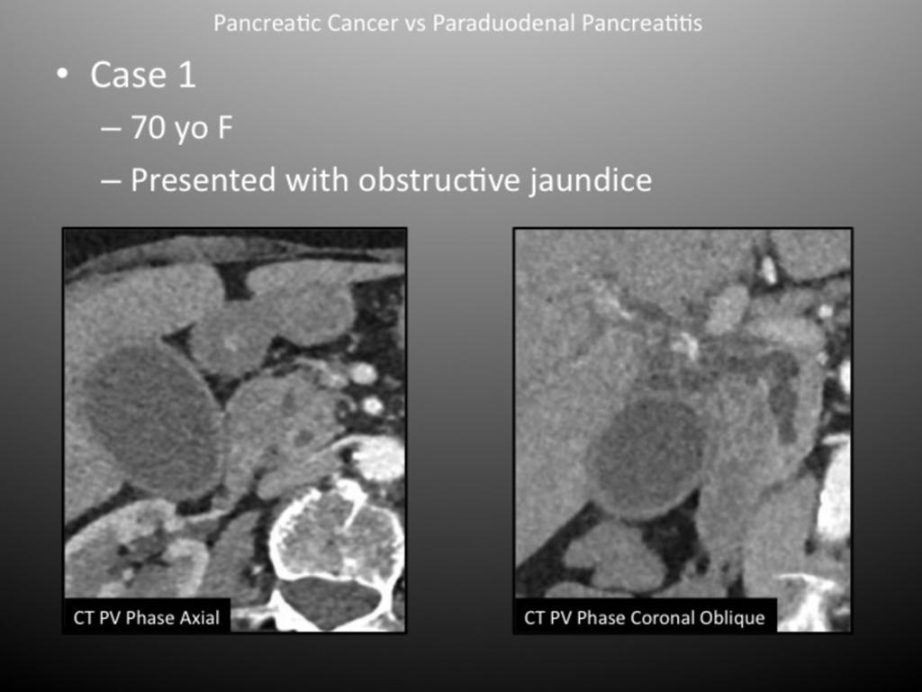 Fig. 5: Pancreatic Cancer in the