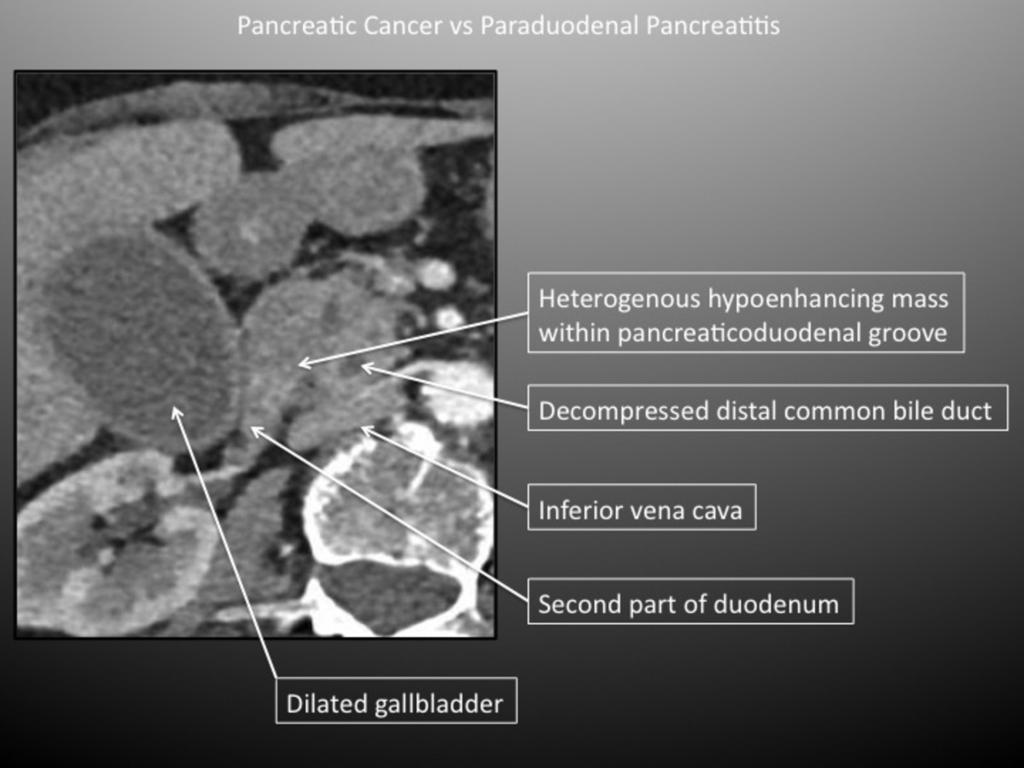 Fig. 6: Pancreatic Cancer in the
