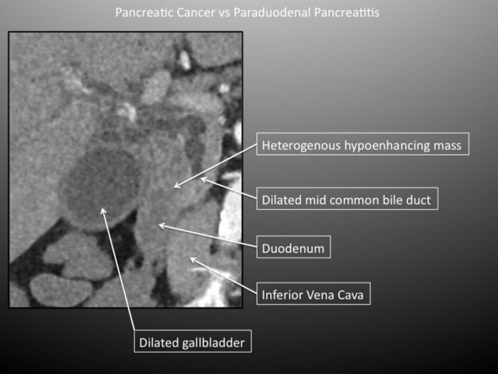 Fig. 7: Pancreatic Cancer in the