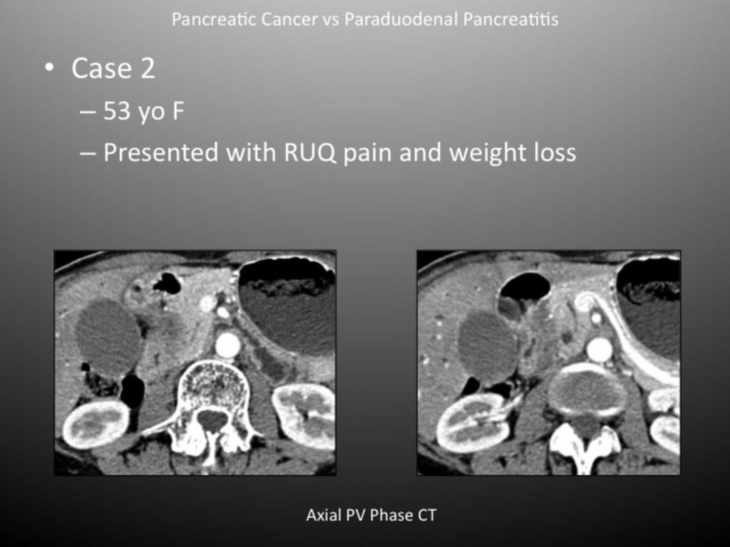 Fig. 9: Pancreatic Cancer in the