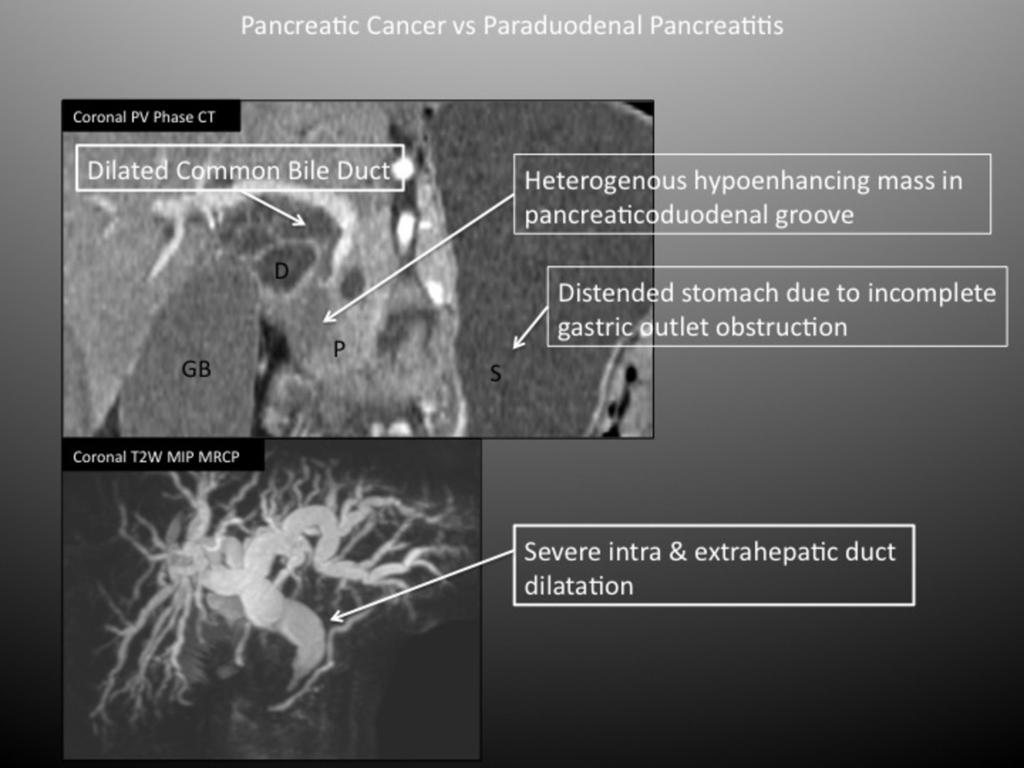 Fig. 10: Pancreatic Cancer in the