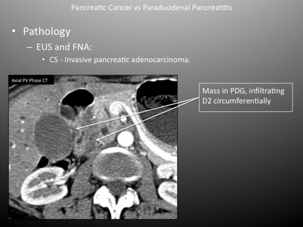 Fig. 11: Pancreatic Cancer in the
