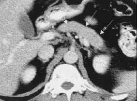 Radiological findings ERCP, ultrasound and CT reveal segmental stenosis of the