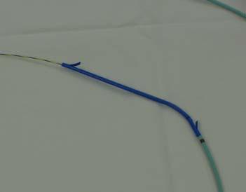 Stricture Diagnosis ERCP Brush cytology- 20-30% sensitivity Duct biopsy-