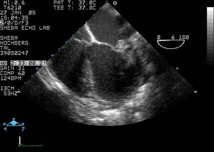 The next day a TEE is performed A large vegetation on the mitral valve with a