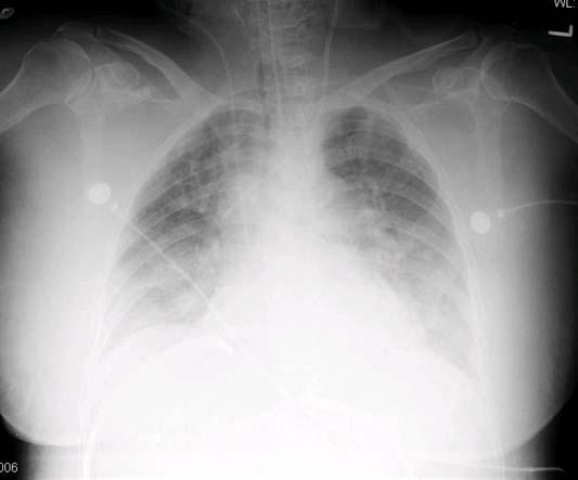 What is the reason for the 1. Cardiogenic pulmonary edema 2. ARDS 3. Pneumonia 4.