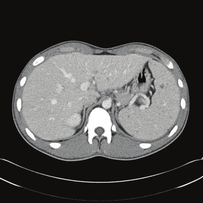 2 Case Reports in Infectious Diseases Figure 1: Computer tomography (CT) of the chest and abdomen. Transverse views showed multiple hepatic and splenic lesions.
