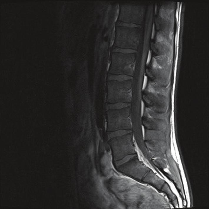 Case Reports in Infectious Diseases 3 Figure 4: MRI of the spine showing lesions in lumbar spine body 2. Figure 6: Follow-up MRI with fluid-filled hepatic lesions.