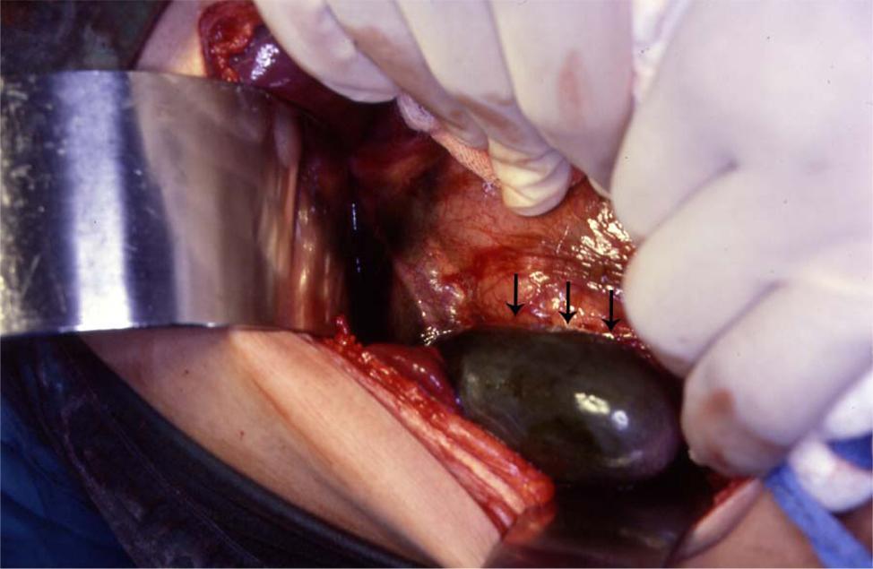 Gangrenous cholecystitis Sequelae or complication Acute