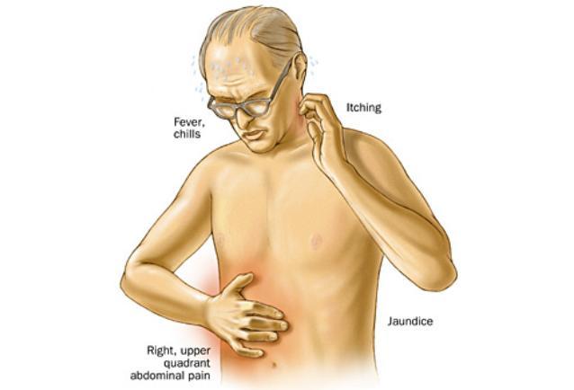 Clinical Charcot s triad (present 2/3 of patient) Fever Epigastrium or RUQ pain Jaundice Reynold s