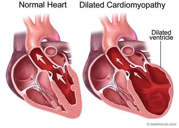 Types of Cardiomyopathy Dilated most common Left Ventricular dilatation Hypertrophic Ventricular muscle