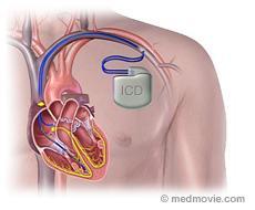 Implantable Defibrillators Primary Prevention Those patients at increased risk of sudden cardiac death, but no history of SCD EF <35%