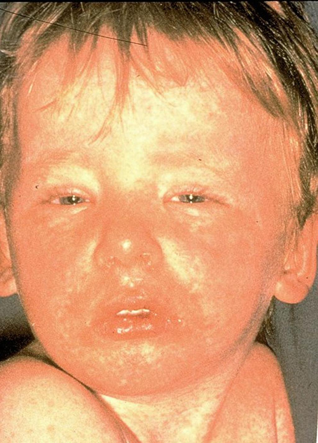 Measles Virus Rash, high fever, cough, runny nose, red and watery eyes Pneumonia,