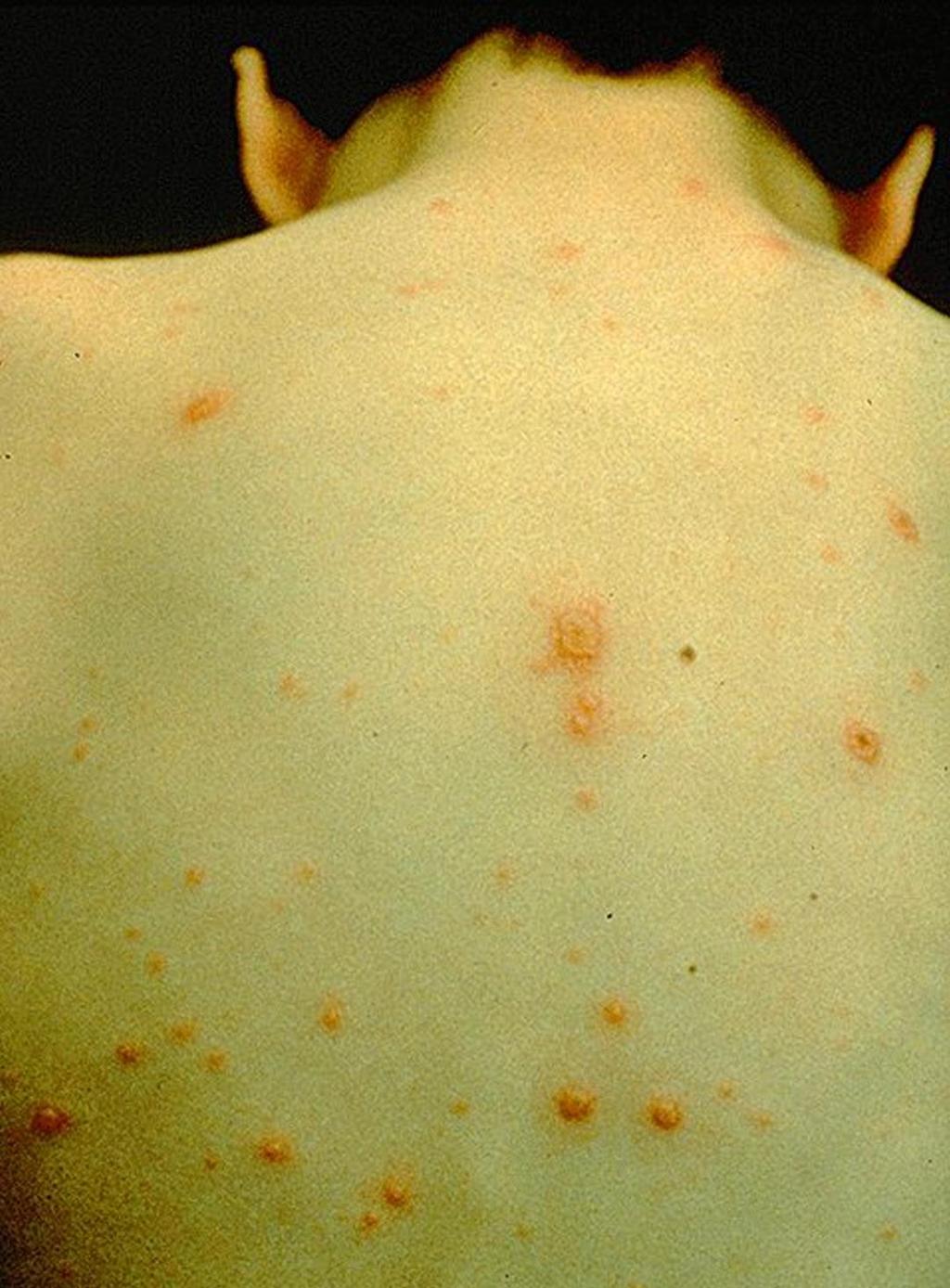 Varicella (Chickenpox) Virus Skin rash of blister-like lesions Bacterial infections