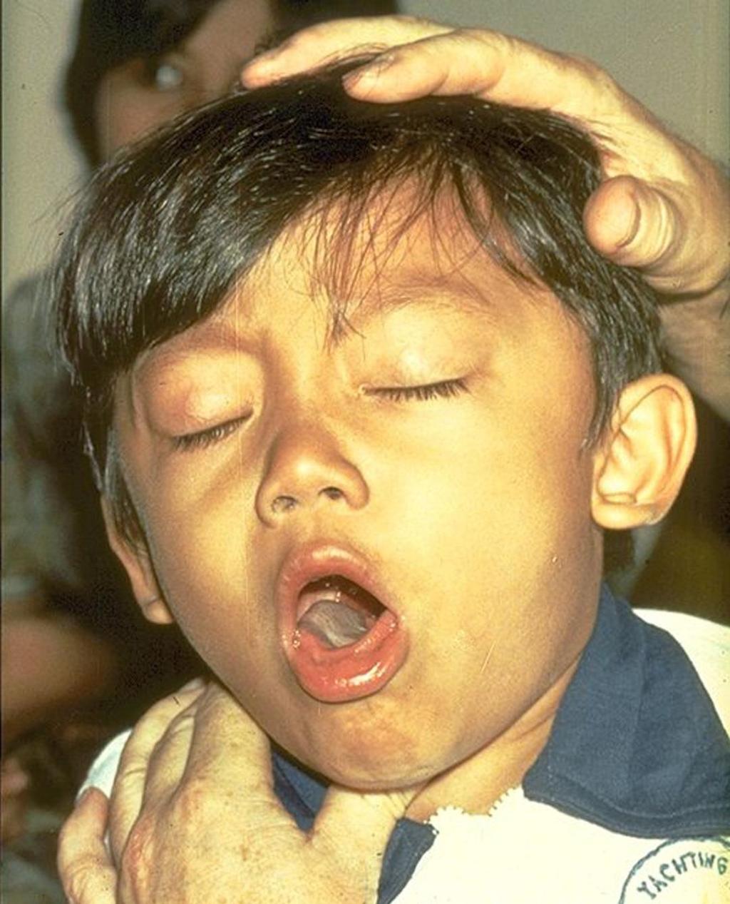 Pertussis (Whooping Cough) Bacteria Severe spasms of coughing interfering with eating, drinking and